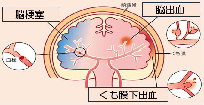 脳卒中