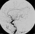 脳血管造影