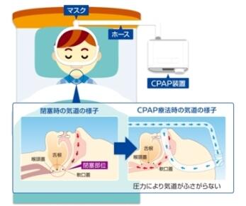 CPAP_2