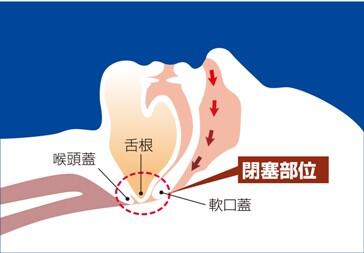 閉塞部位