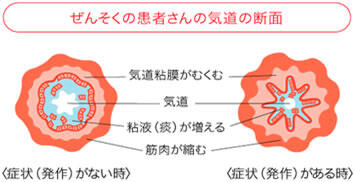 平塚共済病院｜気管支喘息